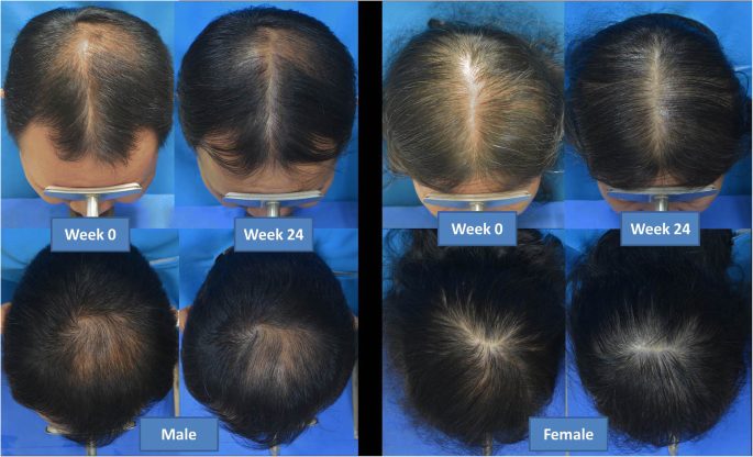 Will a laser hair growth device really help me treat alopecia baldness