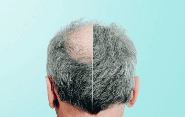 How fast will I see results by using laser hair loss therapy